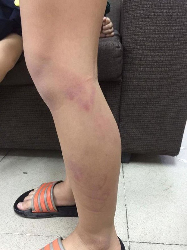 ha-noi-hoc-sinh-lop-2-bi-danh-tim-hai-chan-vi-vao-